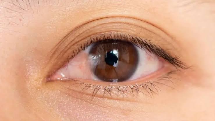 Pterigión ocular